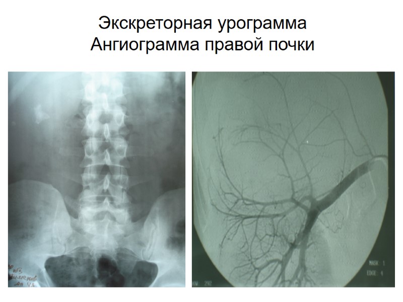 Экскреторная урограмма Ангиограмма правой почки